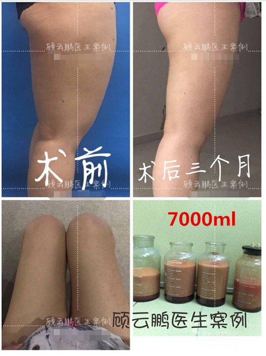 顾云鹏大腿吸脂案例