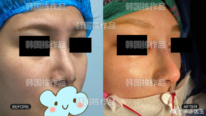 韩国栋鼻修复案例